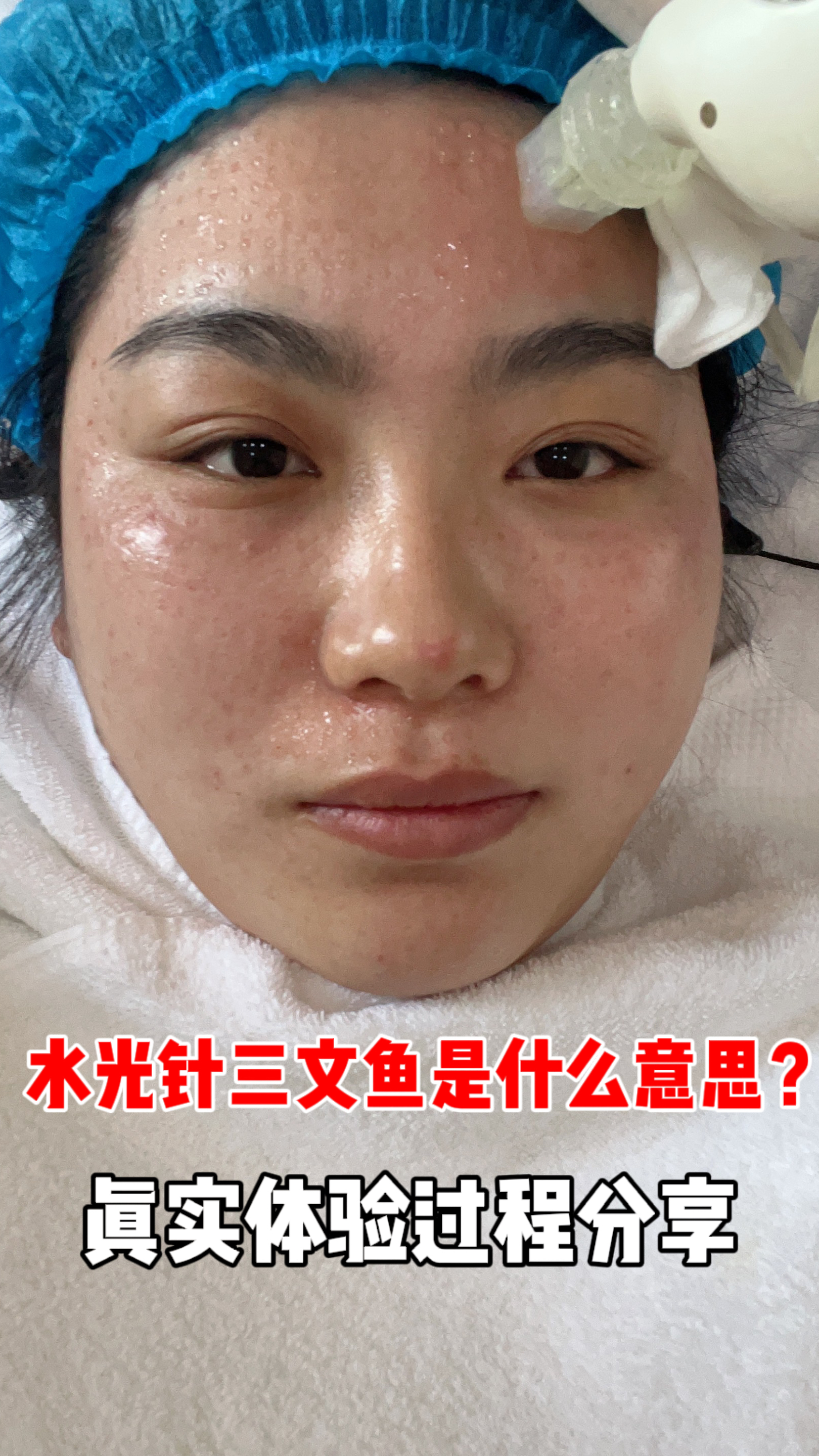 水光针三文鱼是什么意思?真实体验过程分享