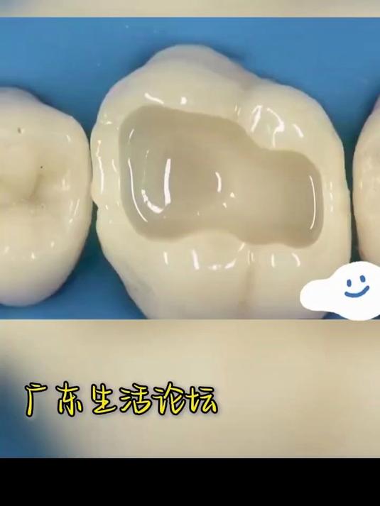 蛀牙修复多少钱一颗