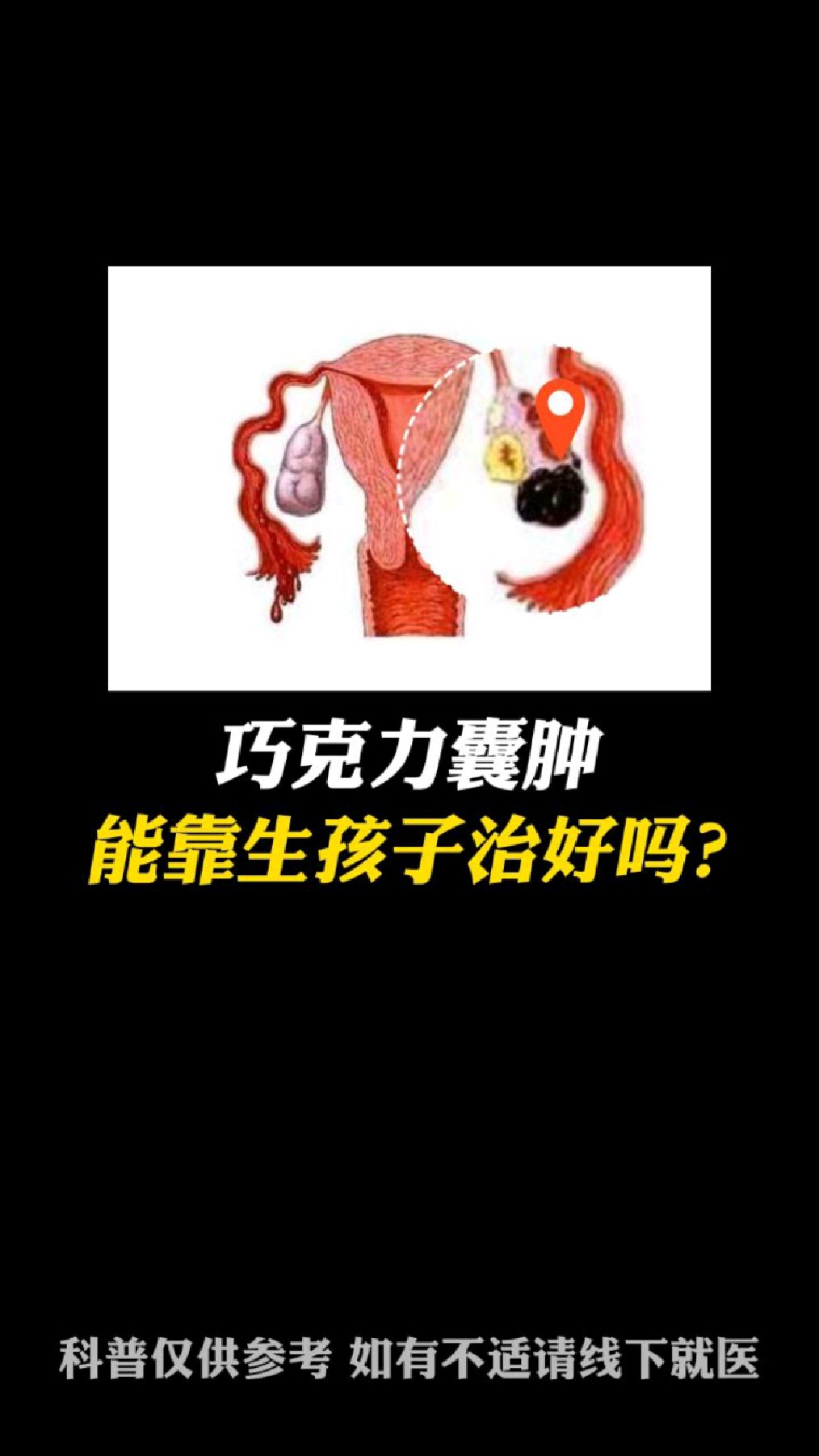 巧克力囊肿能靠生孩子治好吗?没那么神奇,更没那么简单!