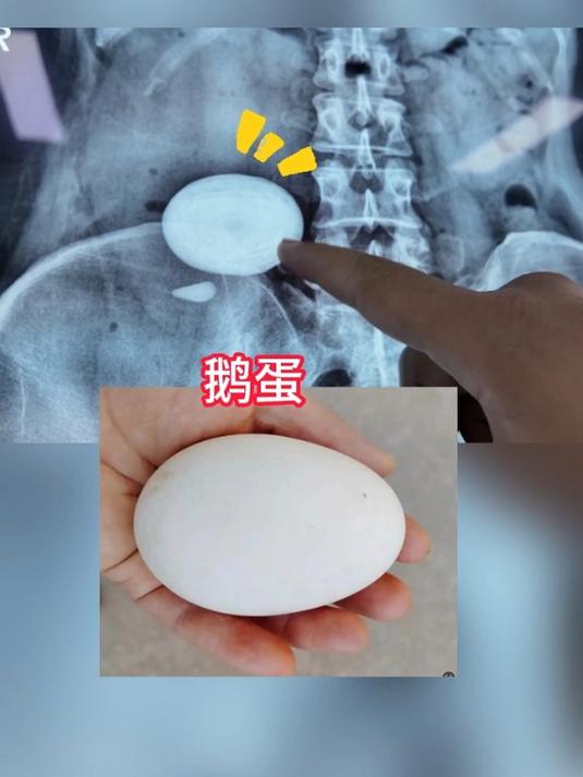 女子不爱喝水,肾脏长出大鹅蛋结石
