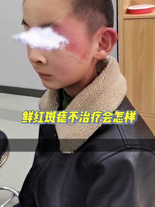 鲜红斑痣不治疗会怎样?