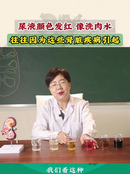 尿液颜色发红,像洗肉水!王悦芬主任:往往因为这些肾病引起