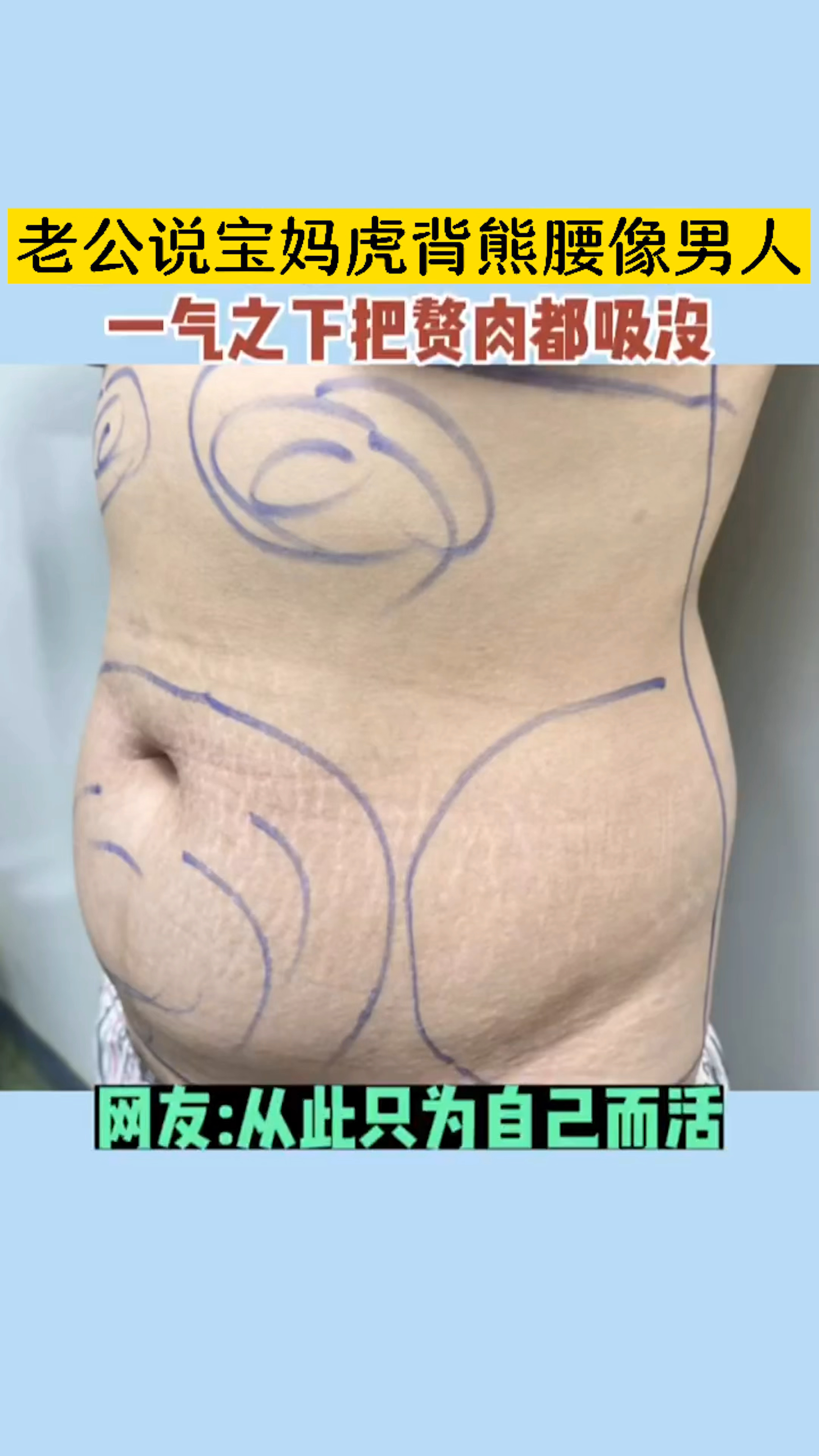 怎么减大肚子?老公说宝妈虎背熊腰像男人,一气之下把赘肉都吸没