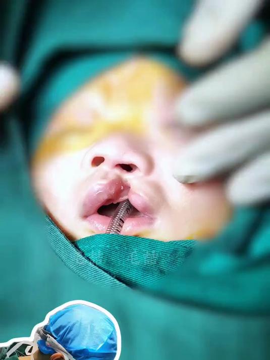 鼻子里凸起的“息肉”竟然是骨头?