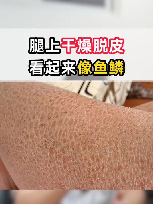 腿上干燥脱皮像鱼鳞