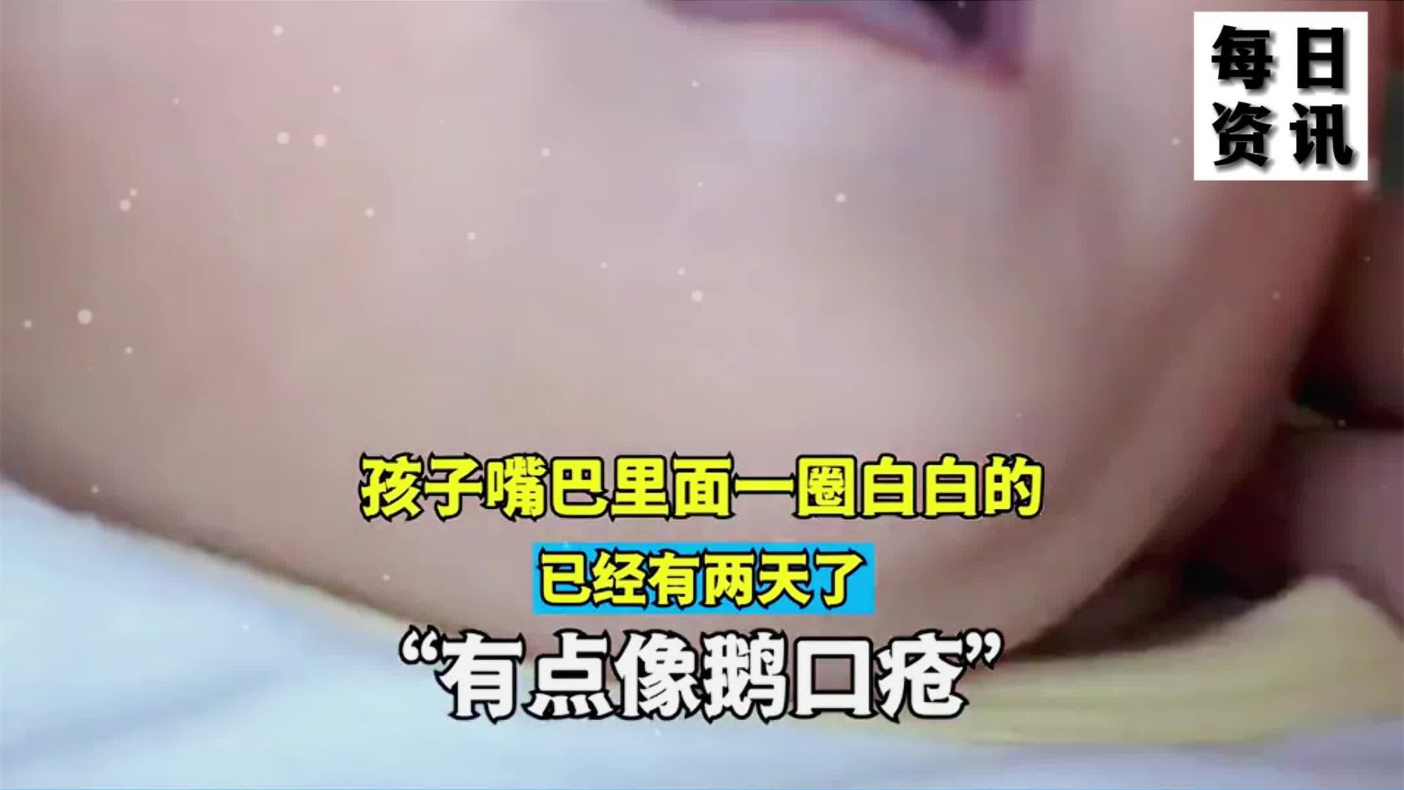 孩子嘴巴里面一圈白白的,已经有两天了,网友:有点像鹅口疮