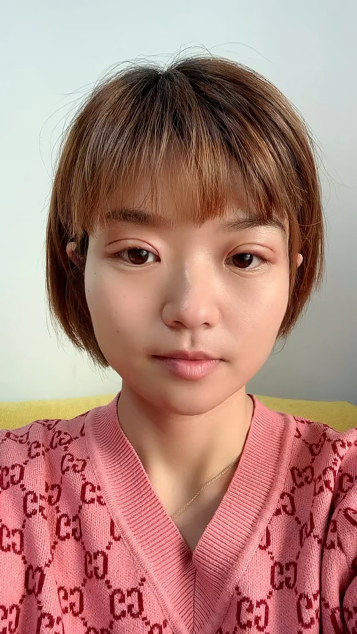 埋线双眼皮第二天肿成这样了,疼但是也要忍受!