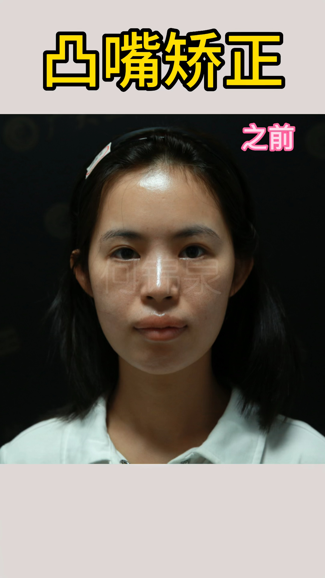 嘴巴凸起导致嘴唇显厚,凸嘴矫正后嘴唇自然～