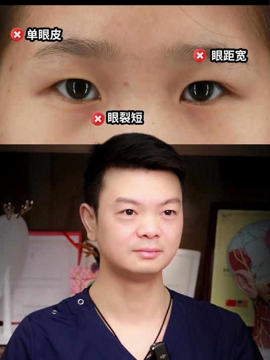 眼距过宽如何改善?鲇鱼系女生变美思路!