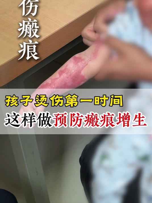 孩子烫伤的第一时间做什么能预防瘢痕增生 #瘢痕修复 #烫伤疤痕 #郑州疤痕医院 #郑大一附