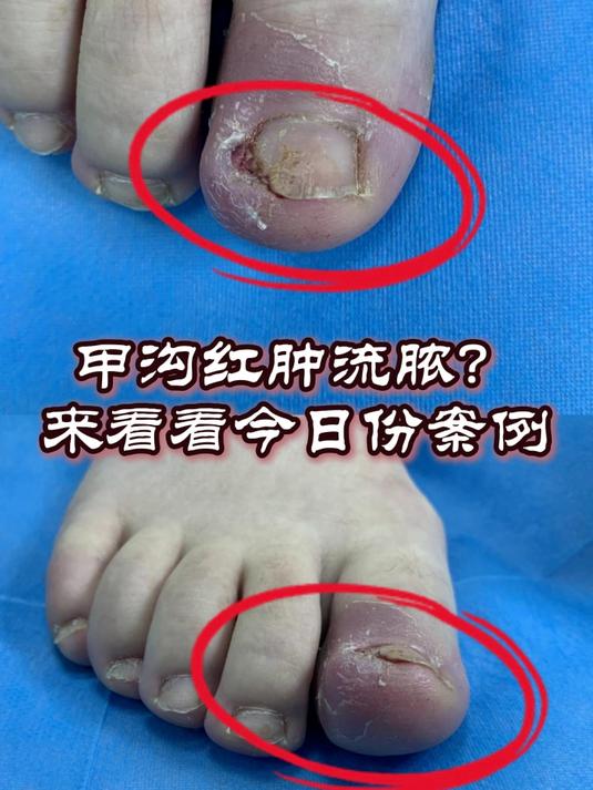 甲沟炎红肿流脓的保守治疗过程
