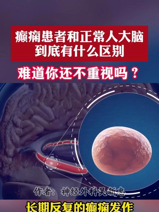 癫痫患者和正常人大脑到底有什么区别