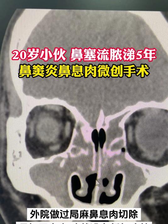 20岁小伙 鼻塞流脓涕5年，鼻窦炎鼻息肉微创手术