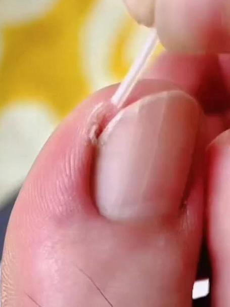指甲疼得要命!分离片垫甲肉,不嵌甲像垫棉花软!