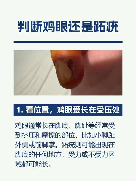 #马上健康过大年#判断鸡眼还是跖疣