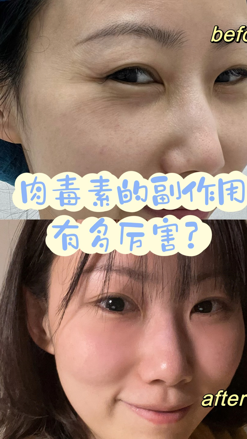肉毒素除皱的副作用有多厉害?你还敢打吗?