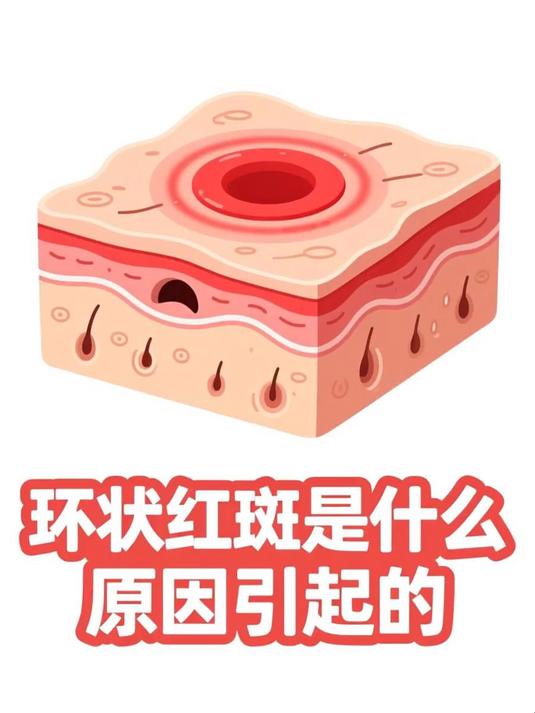环状红斑是什么原因引起的 #健康扬帆季#