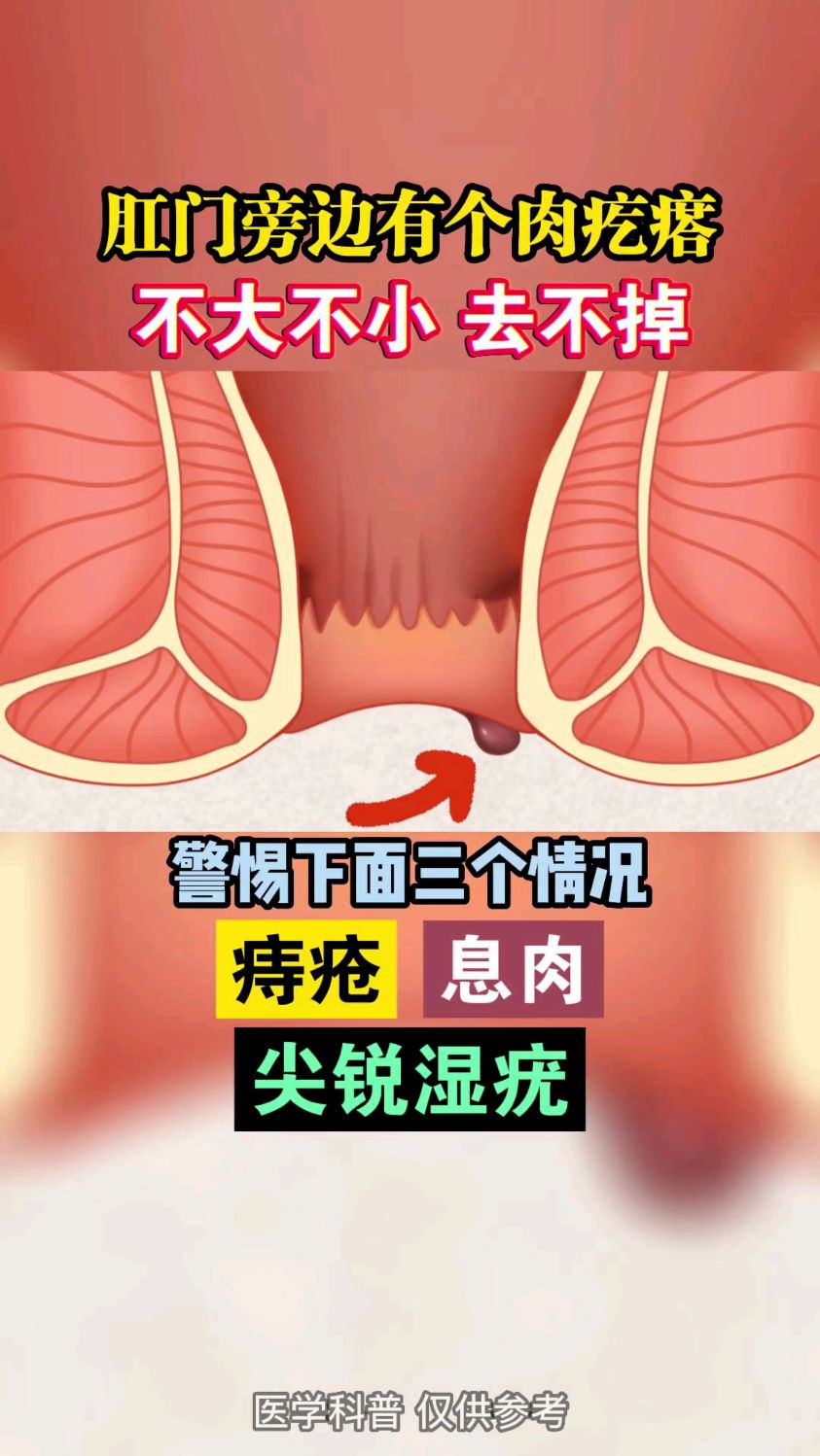 肛门旁边有个肉疙瘩 不大不小 就是去不掉 该怎么办