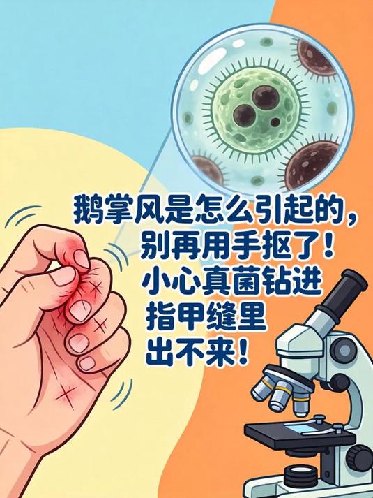 鹅掌风是怎么引起的,别再用手抠了!小心真菌钻进指甲缝里出不来!