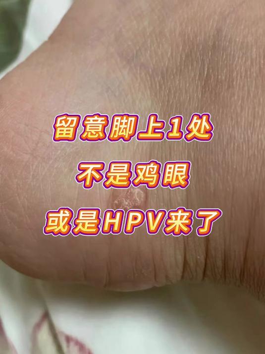 留意脚上1处,不是鸡眼,或是HPV来了