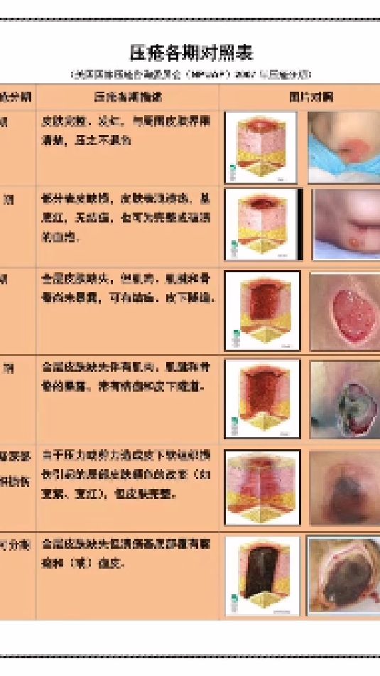 褥疮(压疮)6级分类