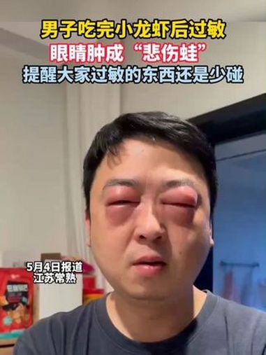 男子吃完小龙虾后过敏眼睛肿成“悲伤蛙”,提醒大家过敏的东西还是少碰。小龙虾过敏