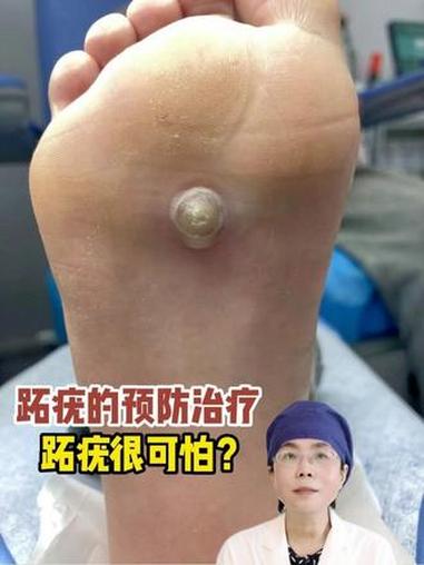 跖疣 跖疣 疣 跖疣冷冻 医学科普