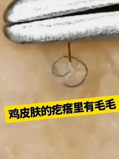 手臂外侧长突起的小疙瘩,摸起来麻麻赖赖的很粗糙,这其实是鸡皮肤 医学科普 鸡皮肤 皮肤 毛