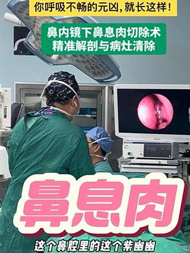 鼻腔大扫除：看医生如何“收割”堵塞呼吸的息肉 你呼吸不畅的元凶，就长这样！医者精神以爱为光