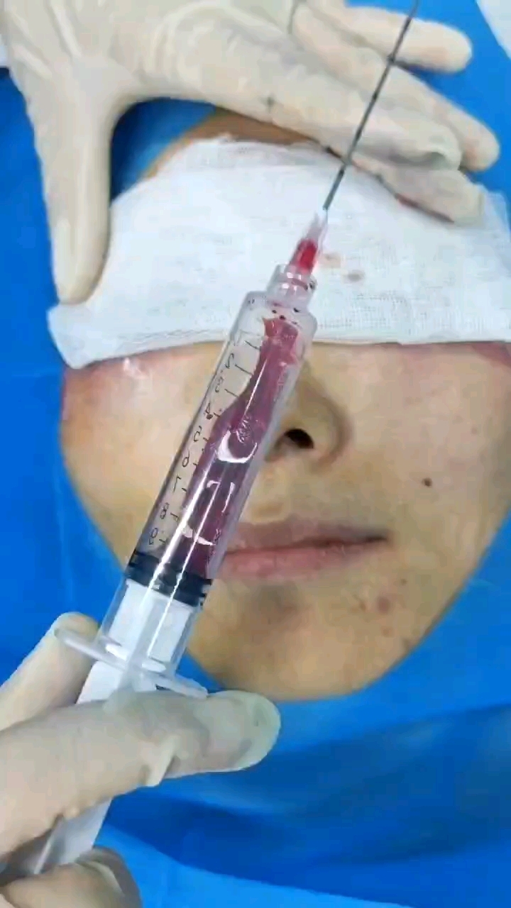 眼袋被注射了不明填充物出现了增生包膜肉芽肿,来看看怎么回事?