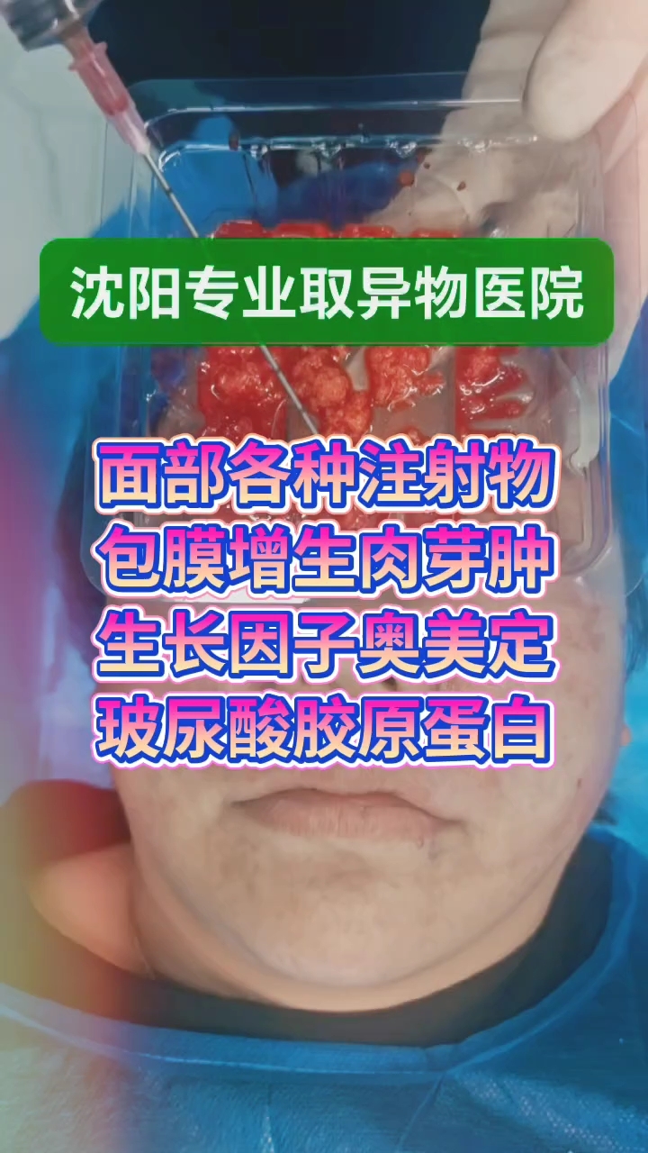 面部注射物出现了硬结增生肉芽肿怎么办?