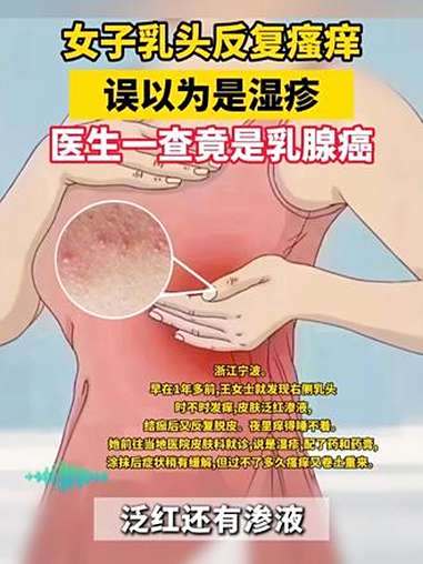 女性必看!警惕湿疹样乳腺癌!千万别当作普通湿疹治疗,今天教大家怎么判断 湿疹 乳腺癌 癌症