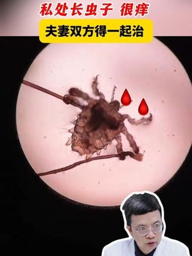 这是长在私处的虫子?这种病得夫妻双方一起治!阴虱 抖出健康知识宝藏 健康无畏自在如她 她们
