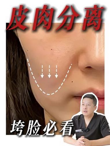 皮肉分离真不能乱填!做这些就可以改善……米兰柏羽 皮肉分离 松弛下垂 面部提升 轮廓固定
