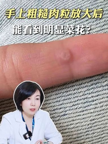 这是手上肉粒在高清镜头下的样子，怕麻烦的试试医生的方法 医学科普 寻常疣 瘊子 HPV 抖