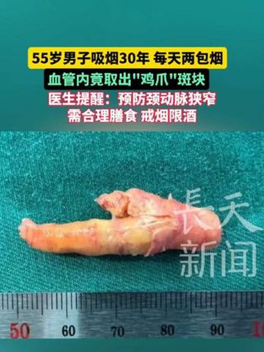 55岁男子吸烟30年 每天两包烟血管内竟取出“鸡爪”斑块 医生提醒:预防颈动脉狭窄 需合理