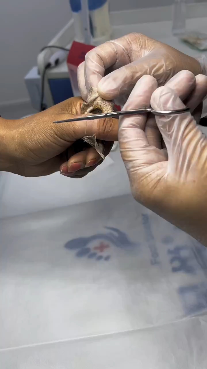 龇牙咧嘴的看完了,跖疣在家贴鸡眼膏没处理好,来店6天修复过程