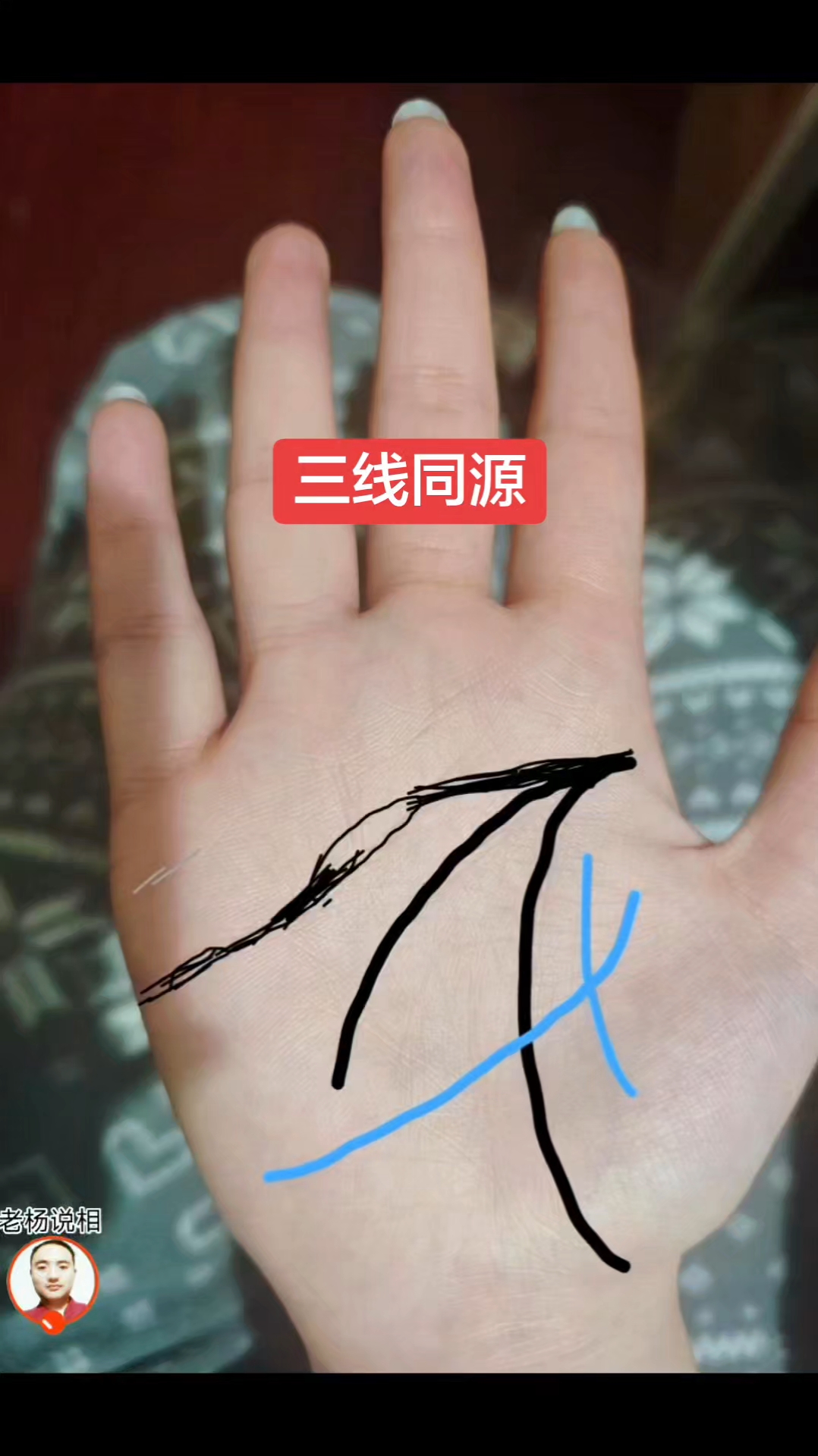手中三线同源,又称鸡爪纹。