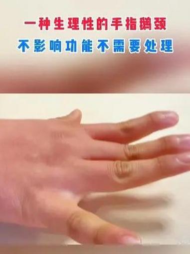 一种生理性的手指鹅颈 不影响功能不需要处理 鹅颈手指手外科#手指畸形