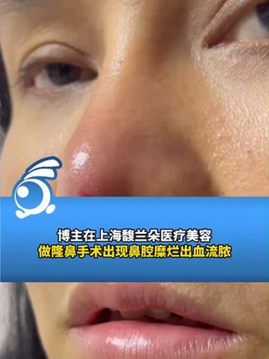 博主在上海馥兰朵医疗美容做隆鼻手术出现鼻腔糜烂出血流脓