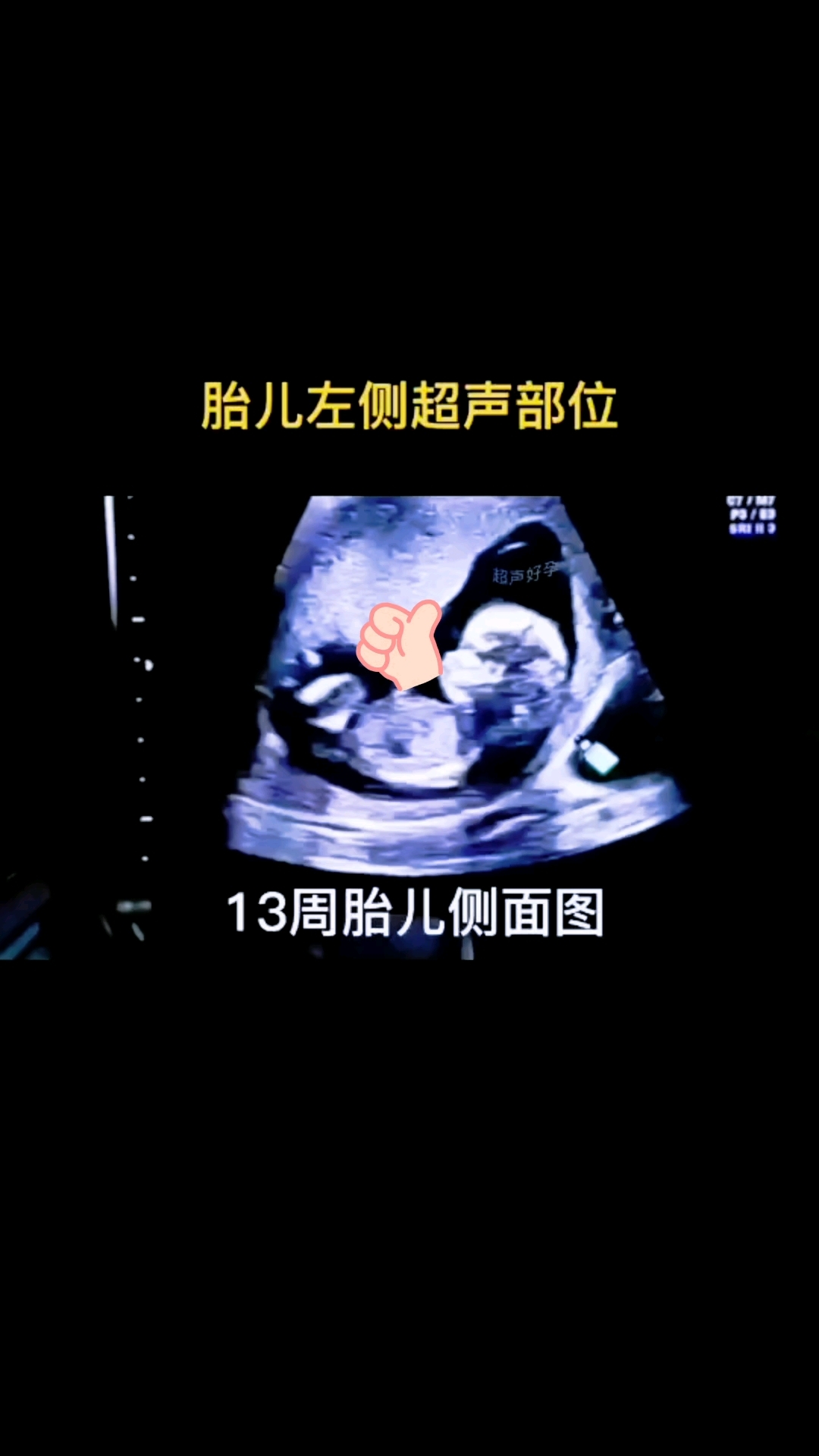 怀孕13周胎儿排畸检查关键期-NT检查(还没有做NT的抓紧)