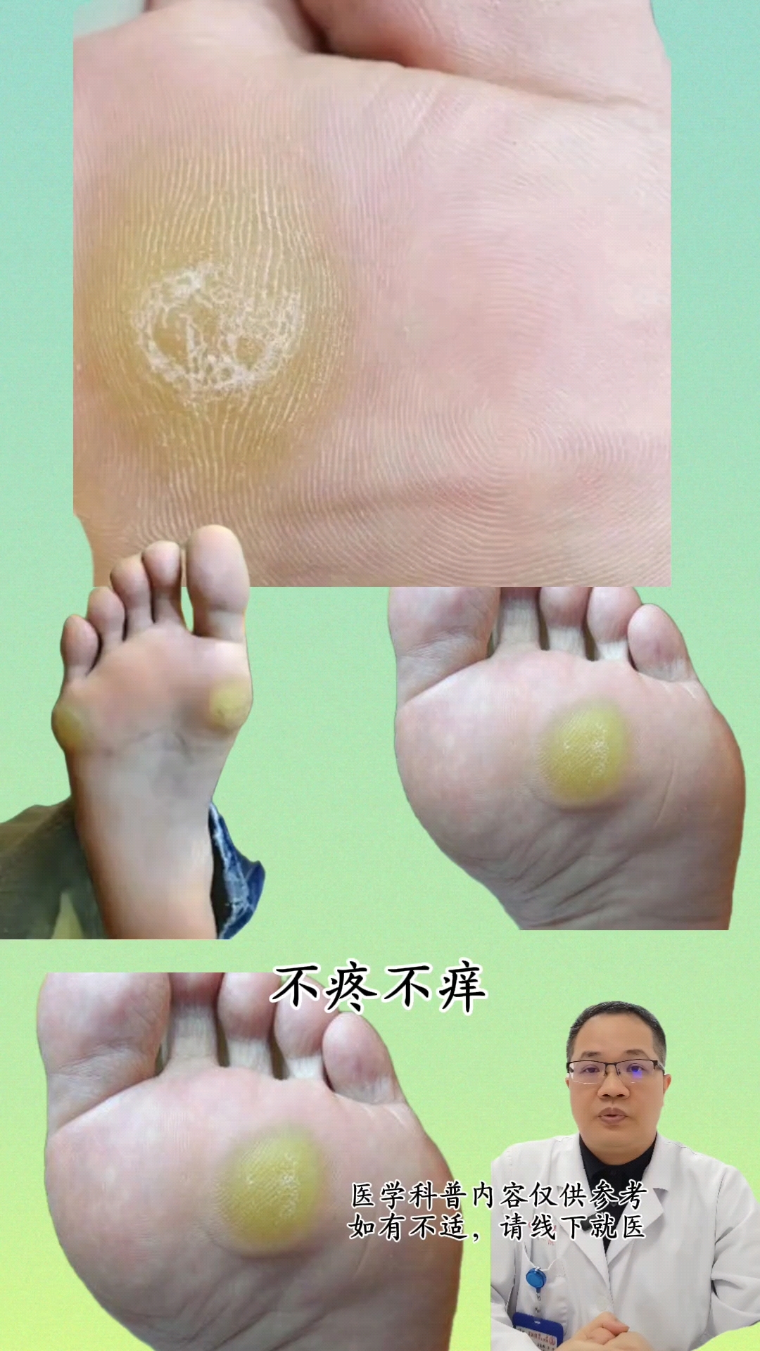 什么是鸡眼和胼胝？