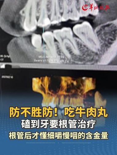 防不胜防!吃牛肉丸磕到牙要根管治疗,长大后才懂细嚼慢咽的含金量 来源 小羊拍客(采访:王中