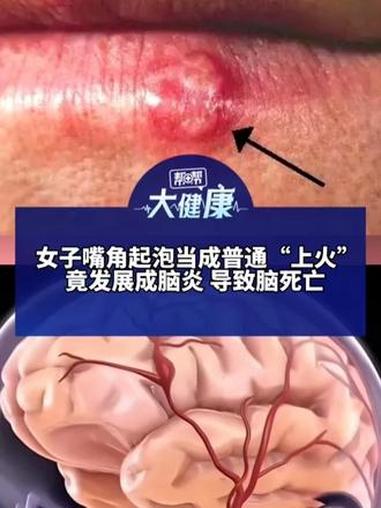 女子嘴角起泡当成普通“上火”竟发展成脑炎 导致脑死亡 医生:疱疹病毒会传染并终身潜伏 疱疹