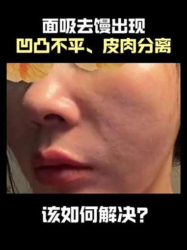 面吸去馒出现凹凸不平皮肉分离该如何解决 面吸去馒出现凹凸不平皮肉分离该如何解决 面吸去馒 
