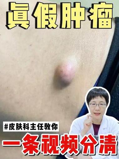 你是不是身上一长肉疙瘩就很慌,担心会不会是肿瘤?医生教你分清 医学科普 皮脂腺囊肿 皮赘 