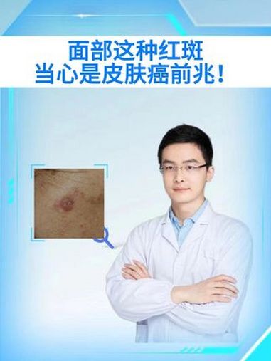 这种面部红斑当心皮肤癌,早发现早治疗 这种面部红斑 医学科普 硬核健康科普行动 皮肤癌