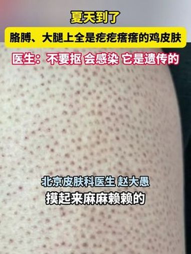 夏天到了，胳膊、大腿上全是疙疙瘩瘩的鸡皮肤，医生：不要抠 会感染 它是遗传的 医学科普 皮