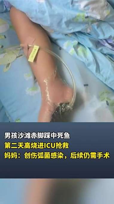 男孩沙滩赤脚踩中死鱼第二天高烧进ICU抢救妈妈:创伤弧菌感染,后续仍需手术