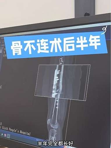 骨不连术后半年,恢复良好 骨不连 诊室日常
